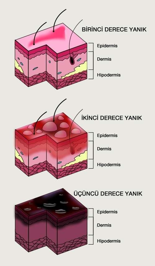 Degree of Burns (or Ambustion)