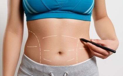 Full Tummy Tuck